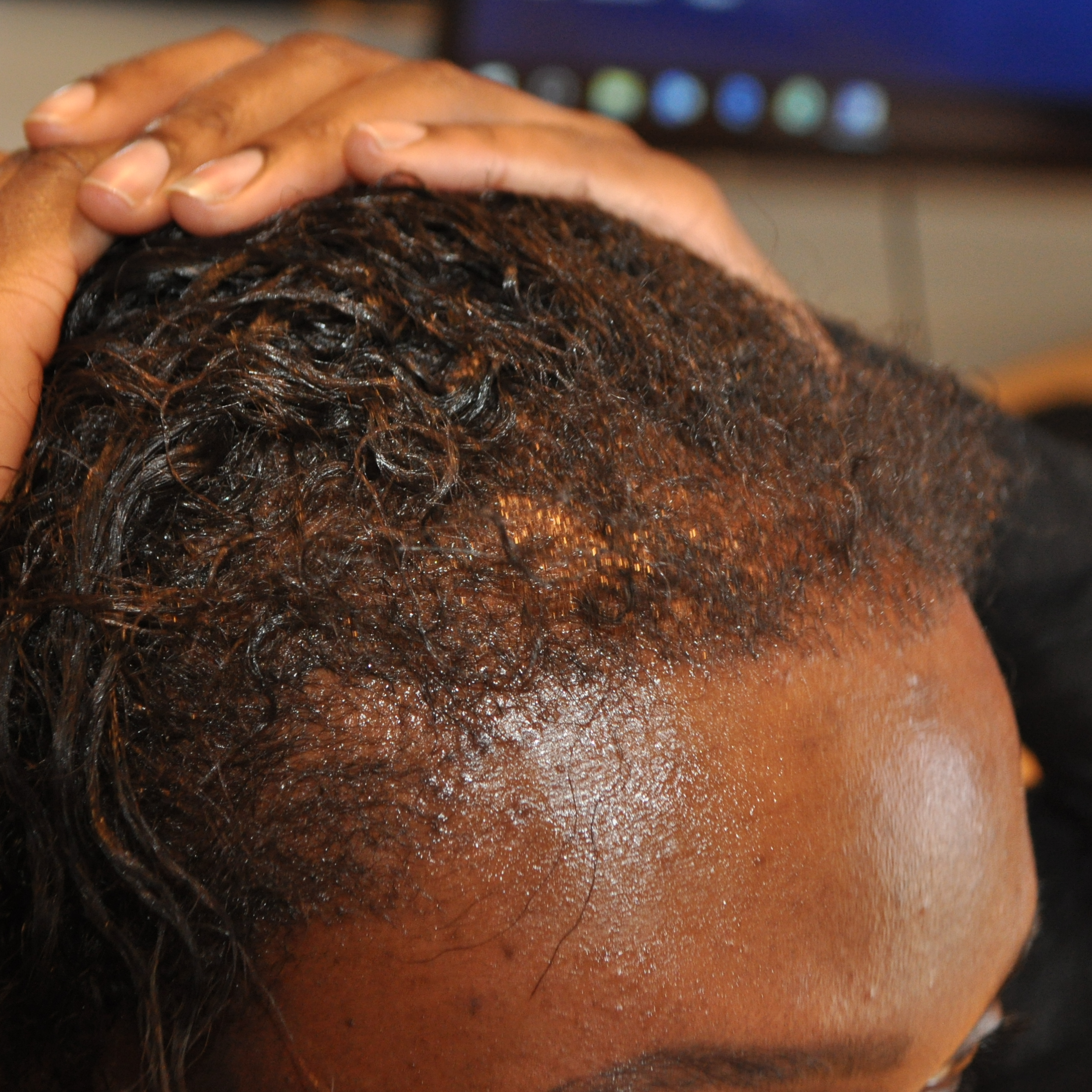 Afro Hair Transplant, Wimpole Clinic