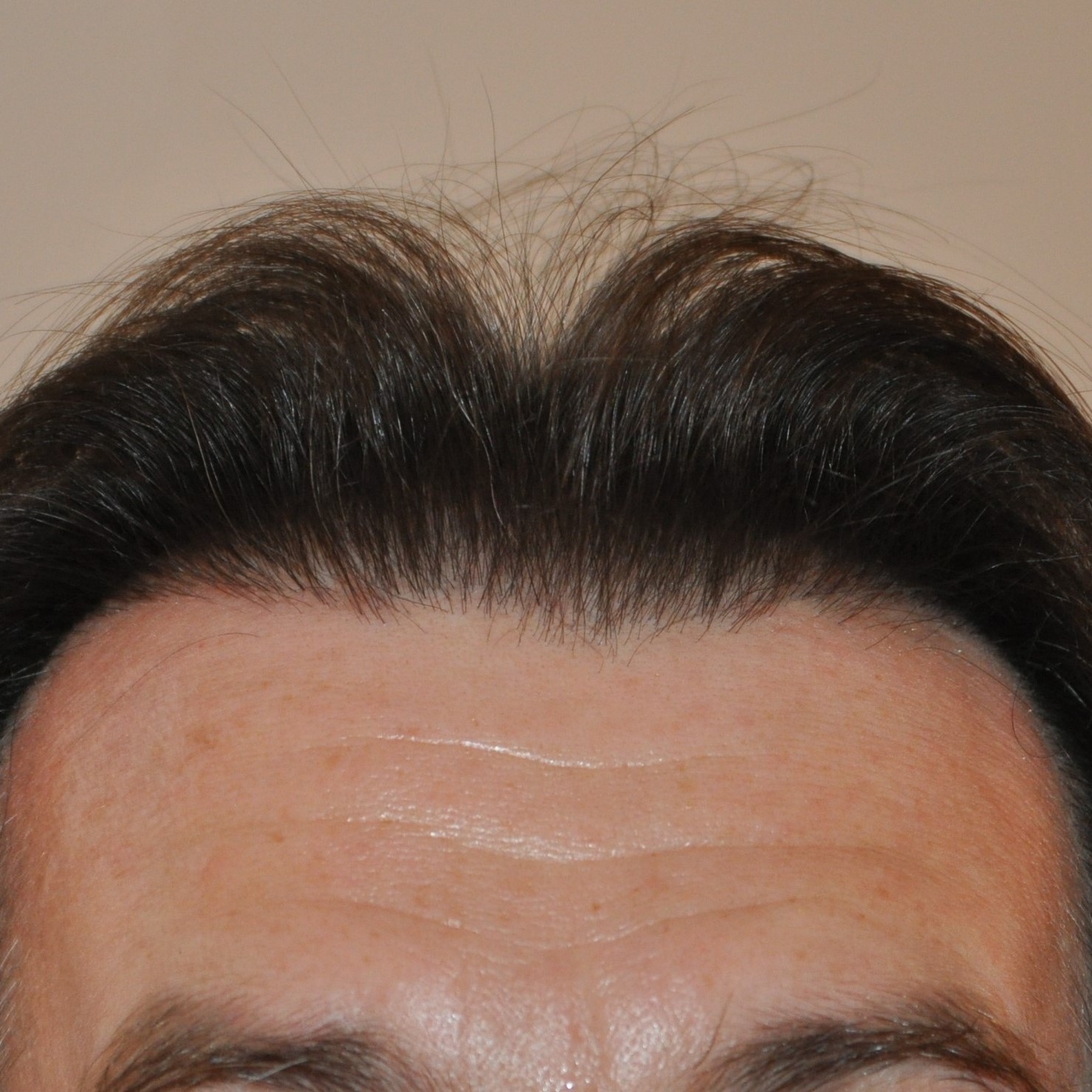 Hairline Transplant, Wimpole Clinic