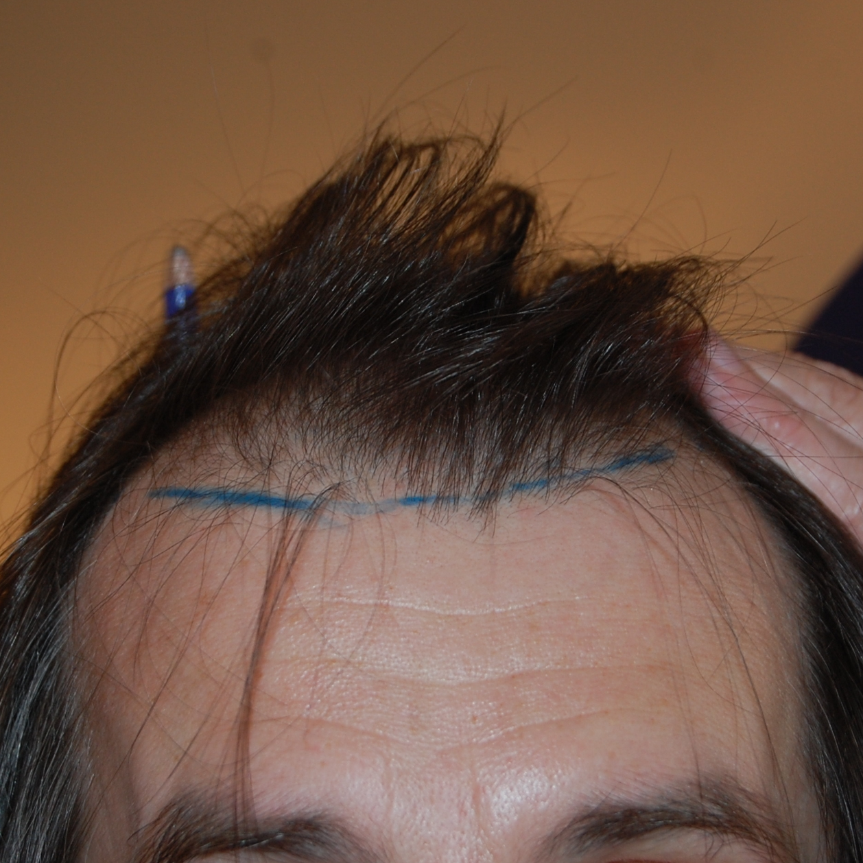 Hairline Transplant, Wimpole Clinic