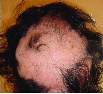 Alopecia sisaipho