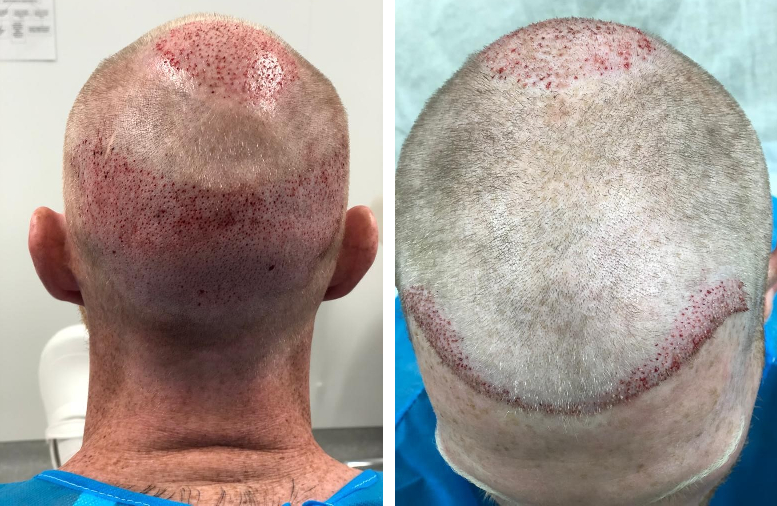 Ben Stokes post hair transplant procedure