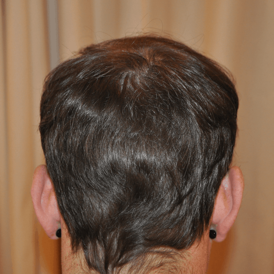 Crown Hair Transplant, Wimpole Clinic