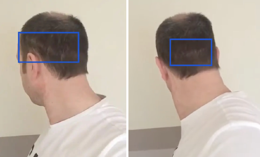 Hair Transplant After 1 Month: Photos, Results, Side Effects, Wimpole Clinic