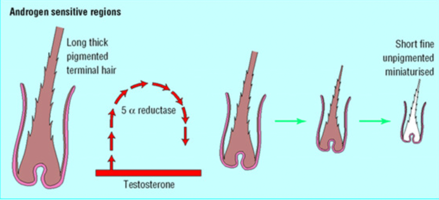 Effects of DHT on hair follicles