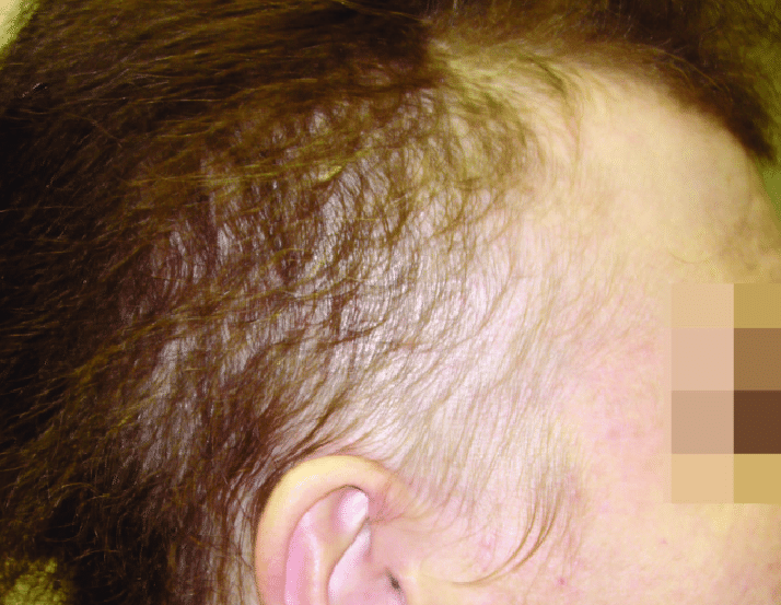 Diffuse alopecia areata