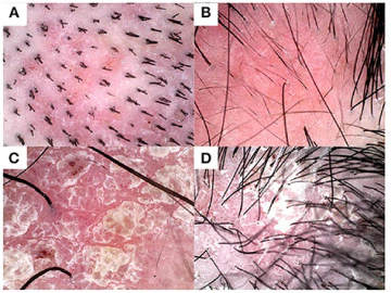 Examples of psoriasis symptoms