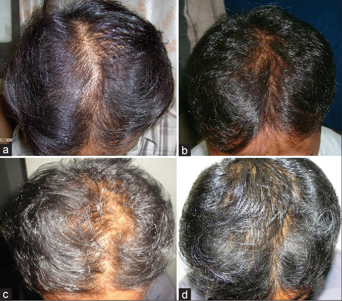 Finasteride combined with Minoxidil