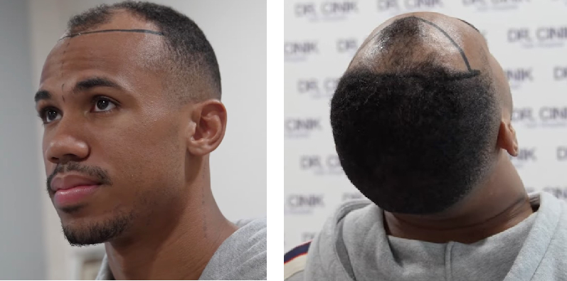 Gabriel Magalhaes's receding hairline before hair transplant at the Turkish Dr Cinik Clinic