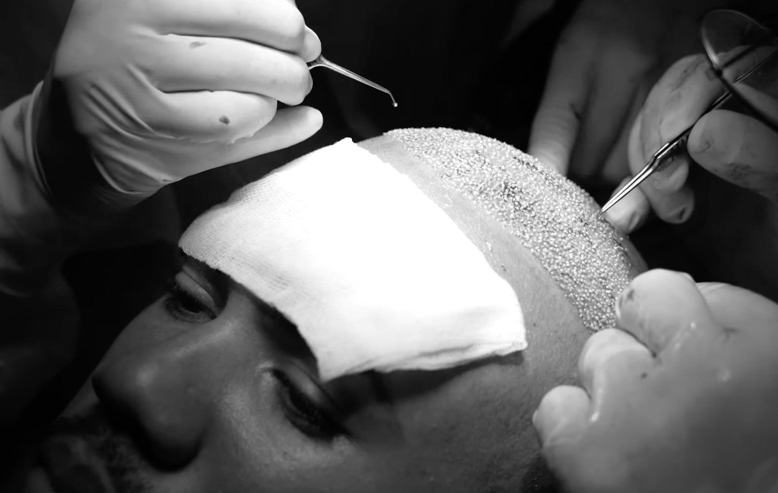 Gabriel Magalhaes mid hair transplant procedure