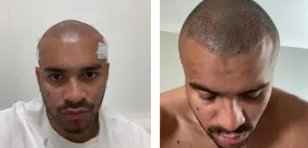 Jonathan Joseph Hair Transplant: Everything You Need To Know, Wimpole Clinic