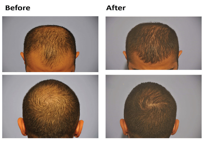 Before and after results of using Minoxidil foam for 6 months