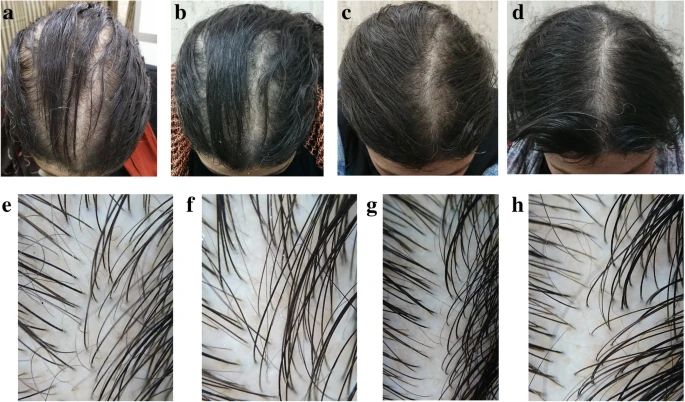 Topical Minoxidil results after 6 months