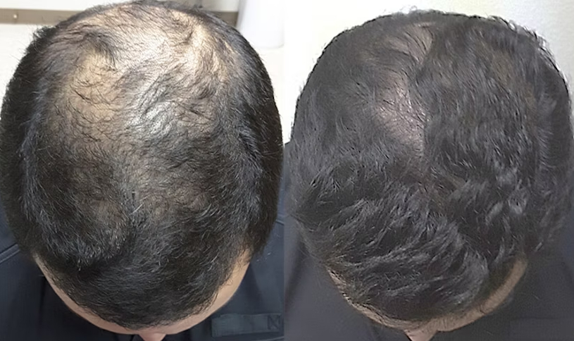 5% Minoxidil results