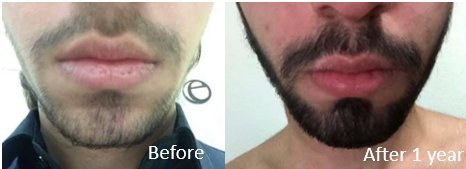 Before and after Minoxidil treatment to regrow beard hair