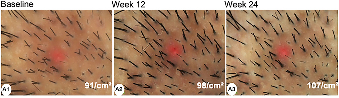 Close-up Minoxidil results at 12 and 24 weeks