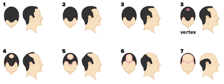 Norwood Scale