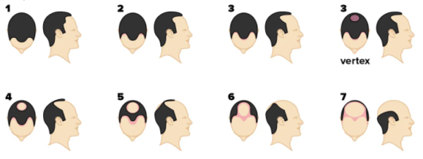 Norwood scale