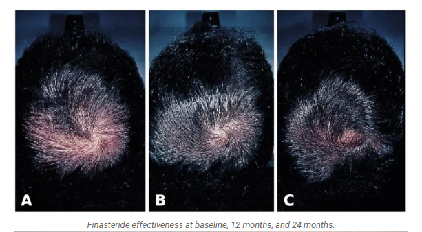 Results of using Finasteride