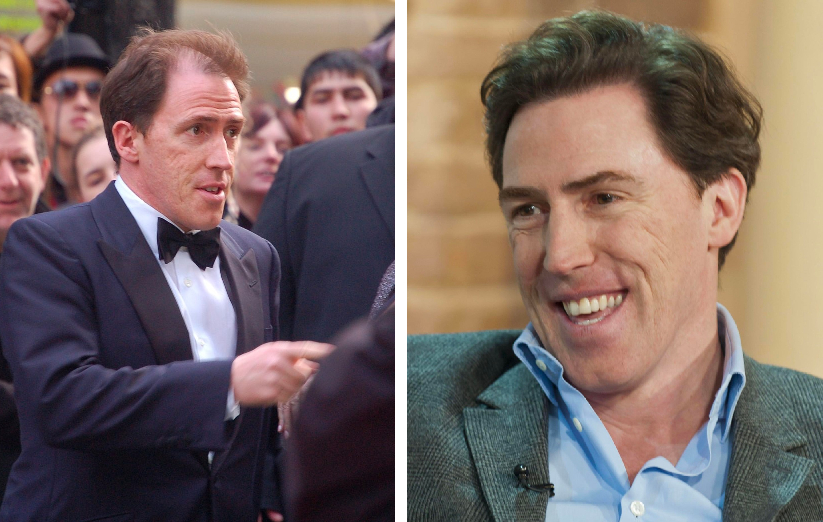 Rob Brydon Before And After Hair Restoration