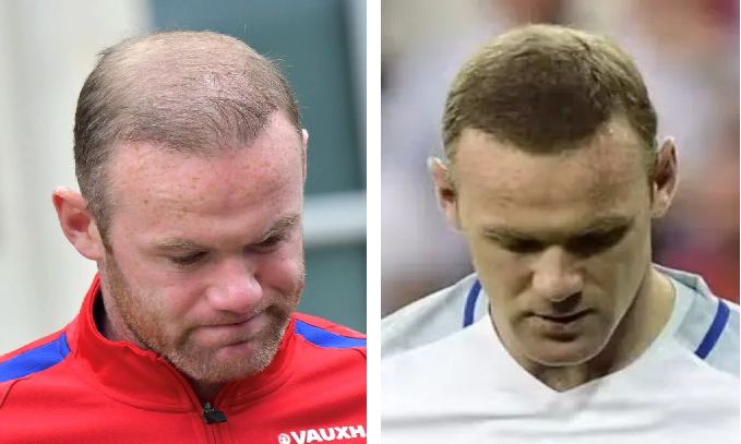 Wayne Rooney before and after hair restoration treatments