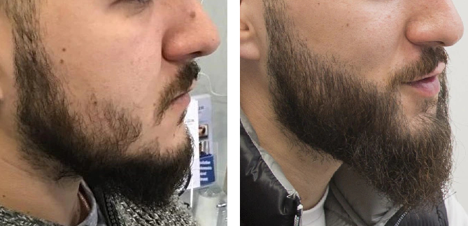 How To Fix Beard Bald Spots, Wimpole Clinic