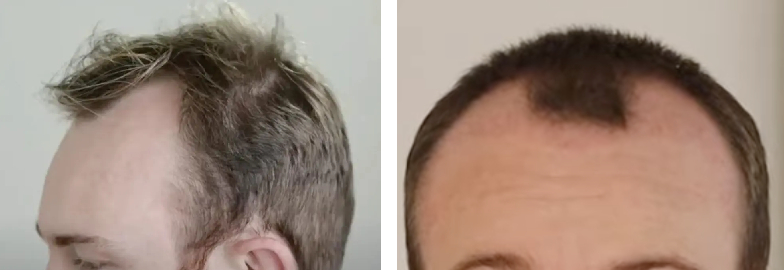 Hair Transplant After 2 Months: Photos, Results, Side Effects, Wimpole Clinic