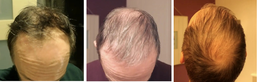 before and 4 months after hair transplant