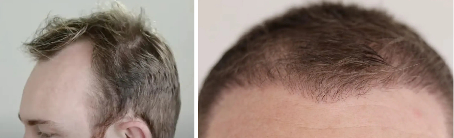 before and 4 months after hair transplantation