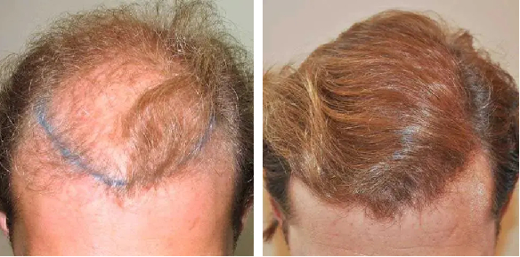 How Many Hair Grafts Do I Need?, Wimpole Clinic