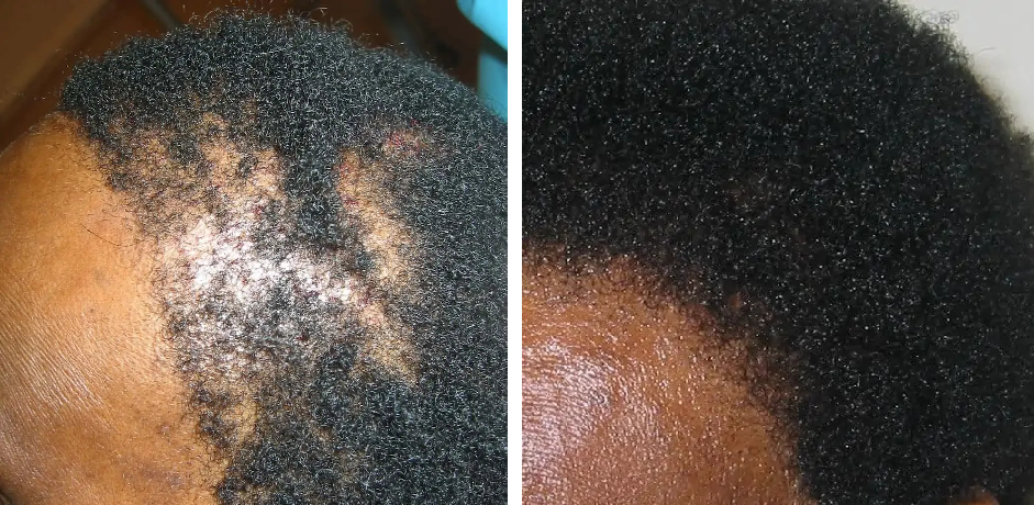 before and after afro hair transplant