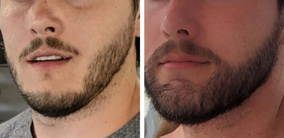 Wimpole patient before and after beard transplant