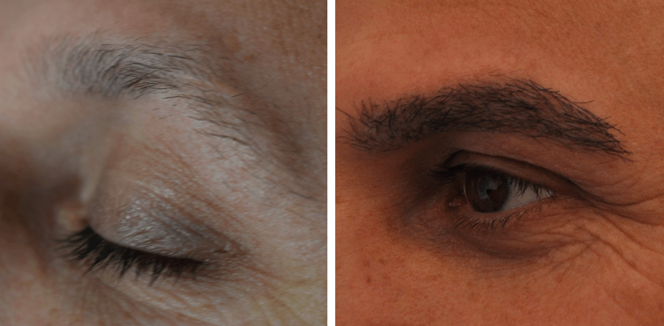 before and after eyebrow hair transplant