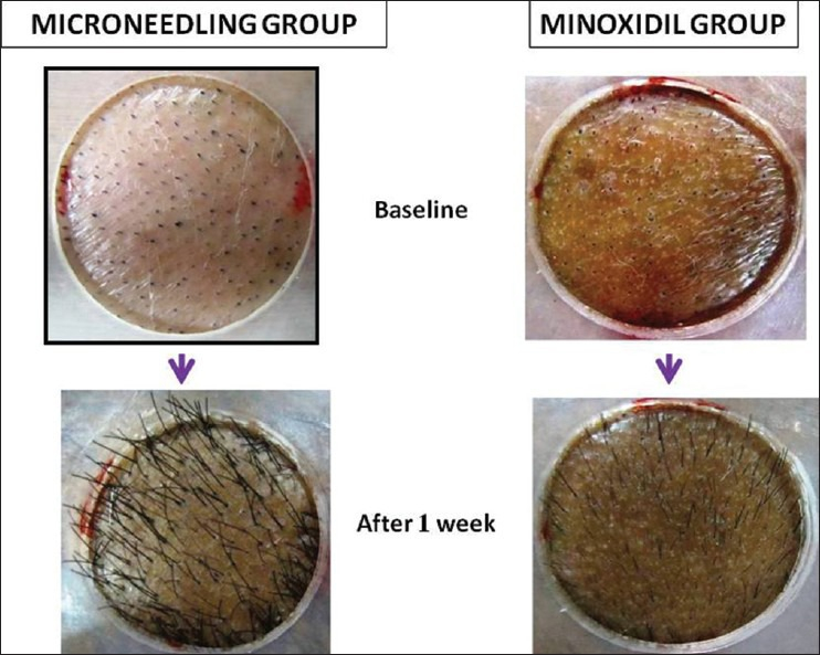 hair growth results comparing micro-needling to Minoxidil