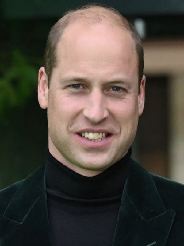 prince william hair loss norwood stage 6