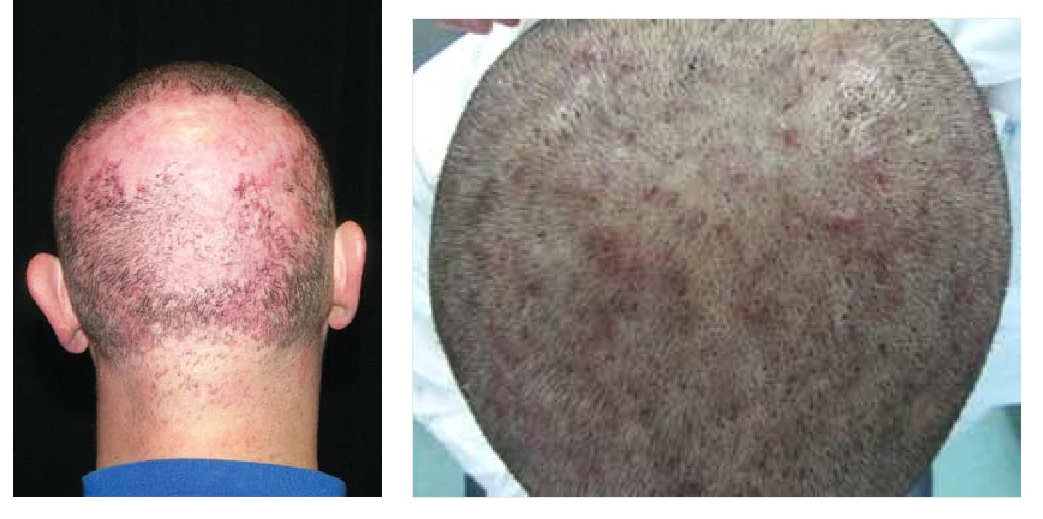 example of folliculitis