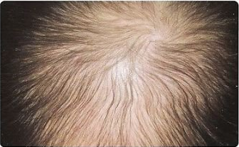 example of medication induced hair loss