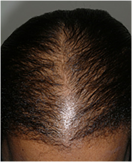 female pattern baldness in a black patient