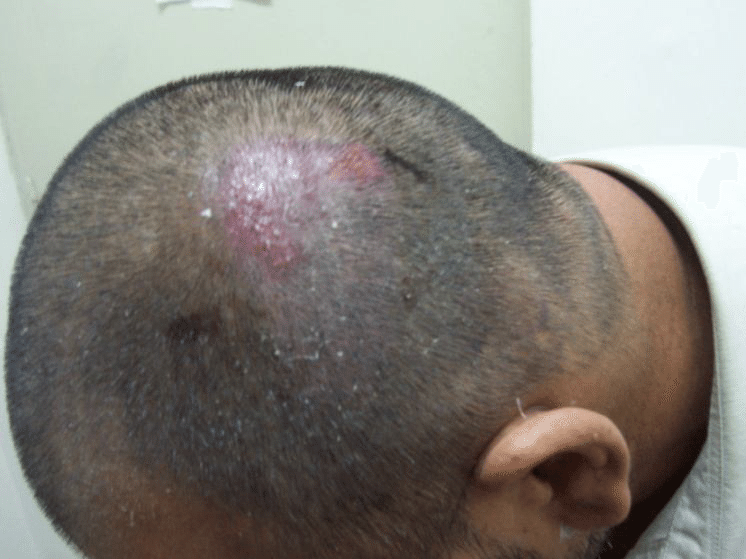 folliculitis after a hair transplant