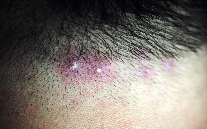 folliculitis on the hairline