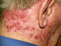 scalp folliculitis on the neck