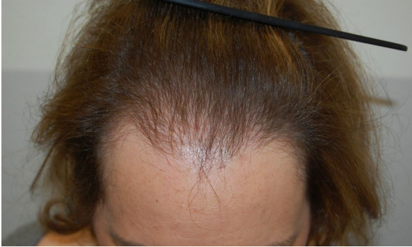 frontal balding due to androgenetic alopecia