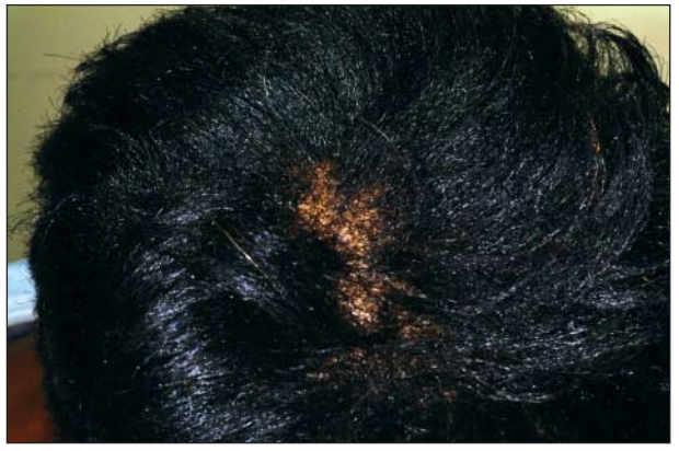 advanced crown hair loss