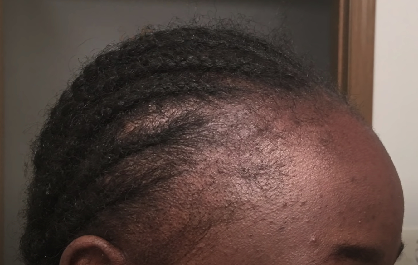 hair breakage on the hairline