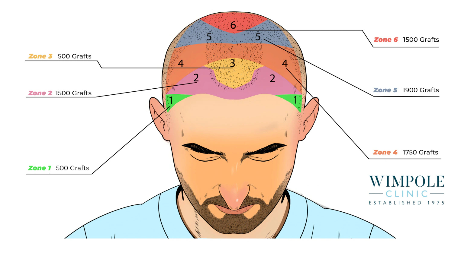 Informational graphic showing how many hair grafts are needed for male hair transplants