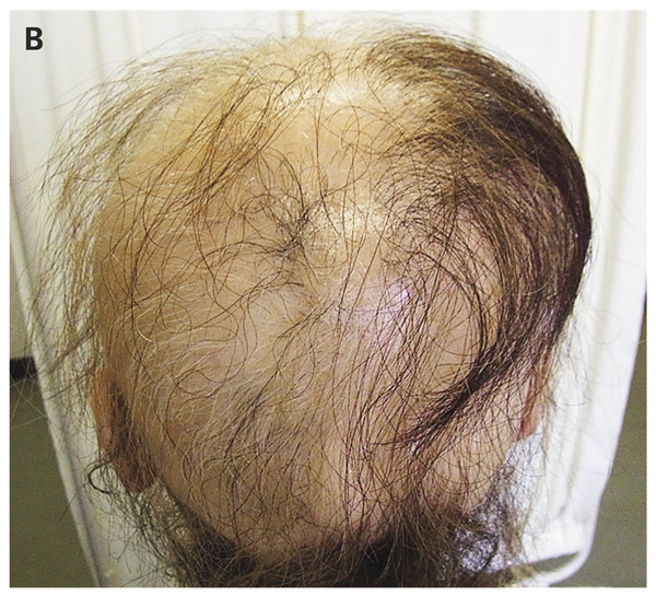 hair loss due to Hashimoto's disease