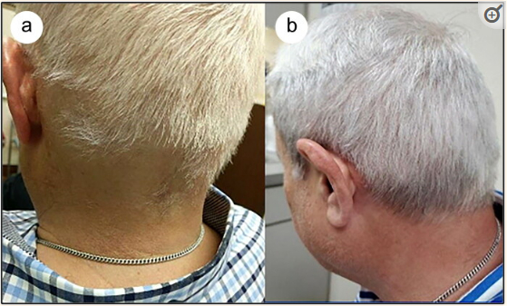 hair regrowth before and after microneedling and steroid treatment