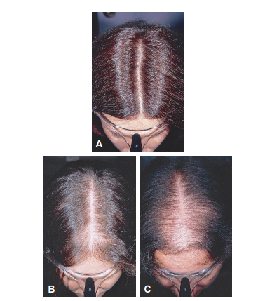 hair thinning in women