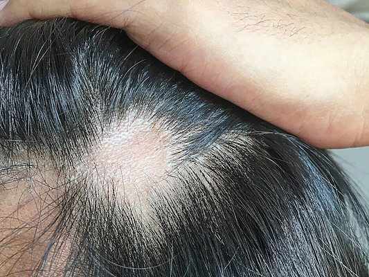 hair transplant into scar featured image