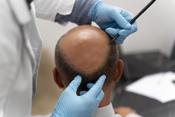 how much does a crown hair transplant cost featured image - Image by Freepik