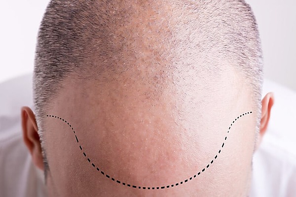 Man Preparing for a Hair Transplant